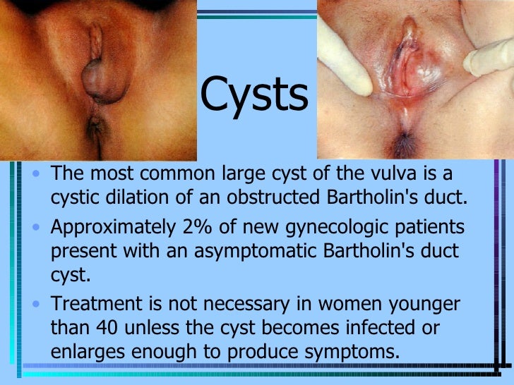 The helpful vagina sebaceous cyst masturbation agree with Thanks for vagina sebaceous cyst masturbation understand